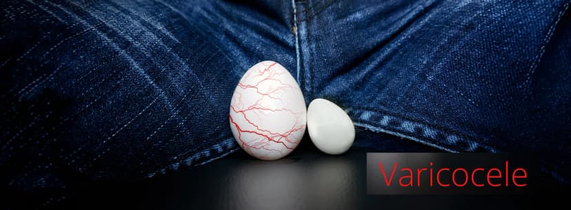 Varicocele surgery for male infertility