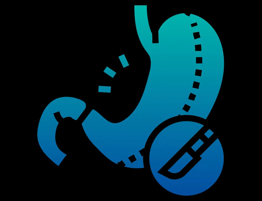 Bariatric Surgery (MIBS)