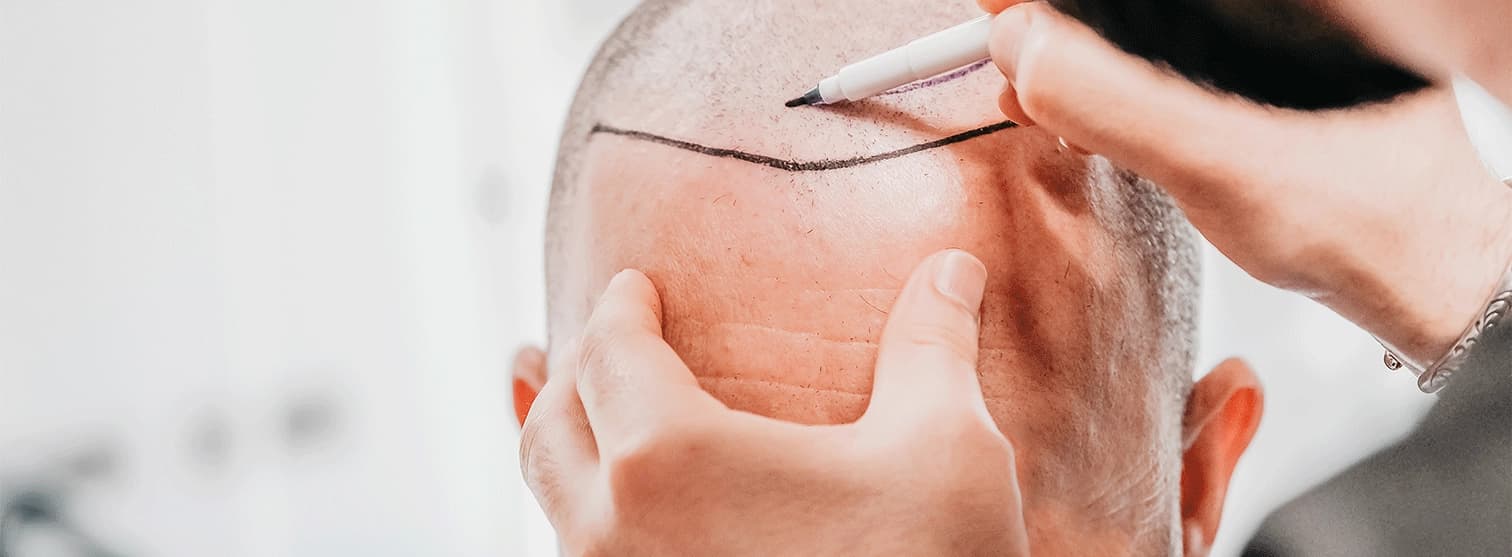 hair transplant surgery procedure hair transplant surgery procedure