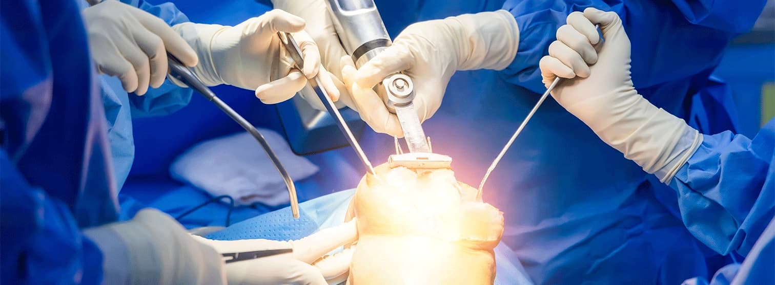 Knee replacement surgery in India for Mauritius patients Knee replacement surgery in India for Mauritius patients