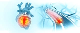 Coronary Angioplasty for International Patients: A Complete Guide for What to Expect After the Procedure Coronary Angioplasty for International Patients: A Complete Guide for What to Expect After the Procedure