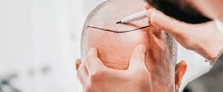 Hair Transplant Surgery: Complete Guide on Procedure, Results, and Recovery for Patients Abroad Hair Transplant Surgery: Complete Guide on Procedure, Results, and Recovery for Patients Abroad