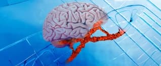 Stroke Treatment and Rehabilitation for Patients Planning Treatment Abroad Stroke Treatment and Rehabilitation for Patients Planning Treatment Abroad