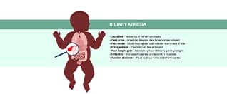 Understanding Paediatric Liver Transplant: Challenges and Innovations Understanding Paediatric Liver Transplant: Challenges and Innovations