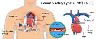 Why Mauritians Choose India for Heart Surgery – A Complete Guide Why Mauritians Choose India for Heart Surgery – A Complete Guide