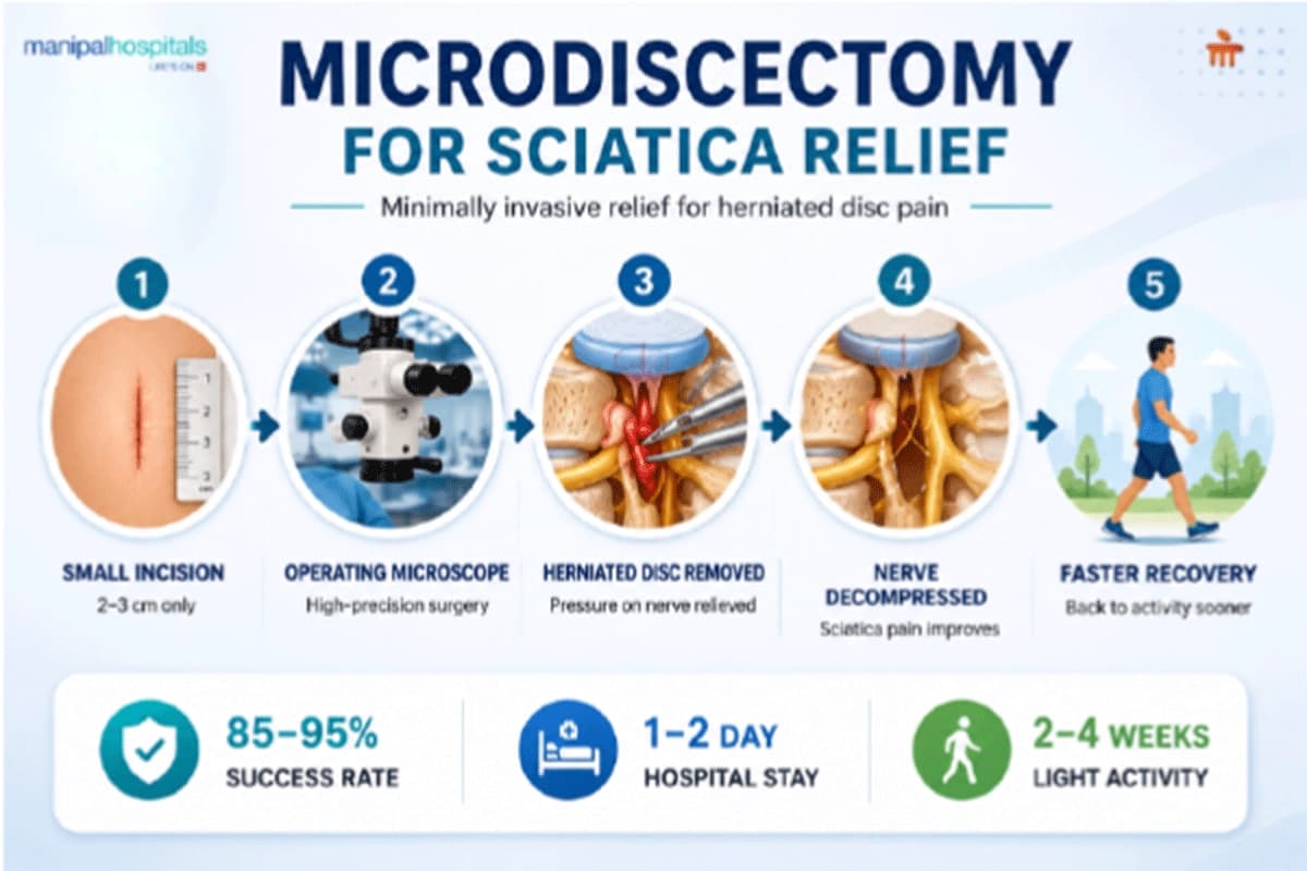 Microdiscectomy for Sciatica Relief