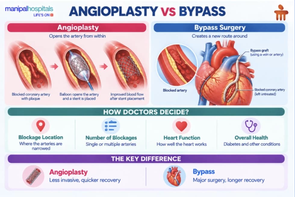Angioplasty vs Bypass Surgery Differences Angioplasty vs Bypass Surgery Differences