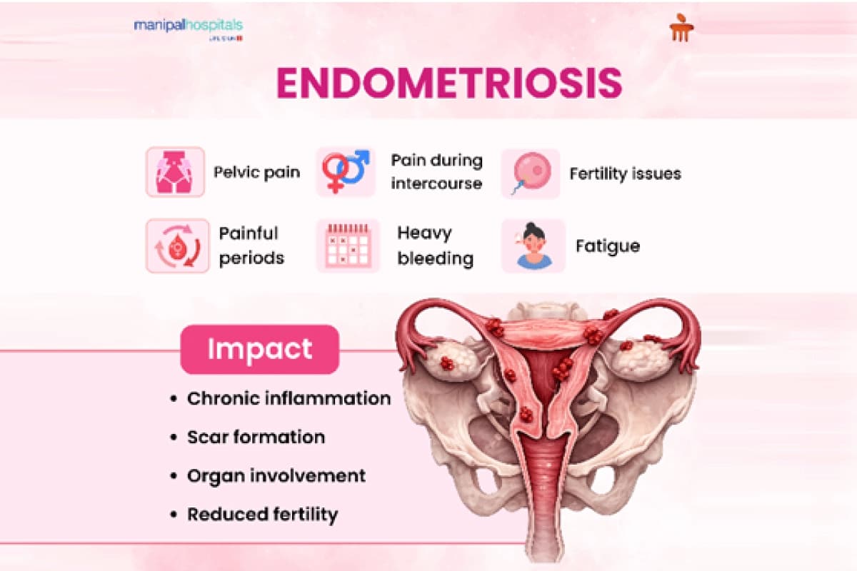 Endometriosis Treatment & Surgery Options Endometriosis Treatment & Surgery Options