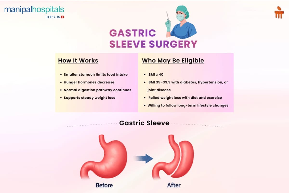 Gastric Sleeve Surgery Procedure Gastric Sleeve Surgery Procedure