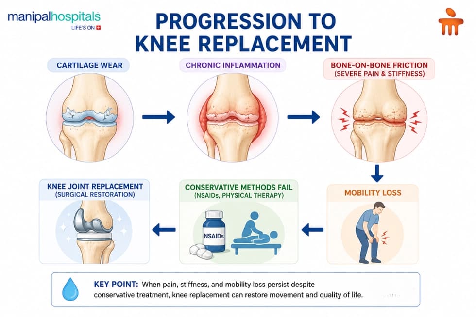Progression to Knee Replacement Progression to Knee Replacement