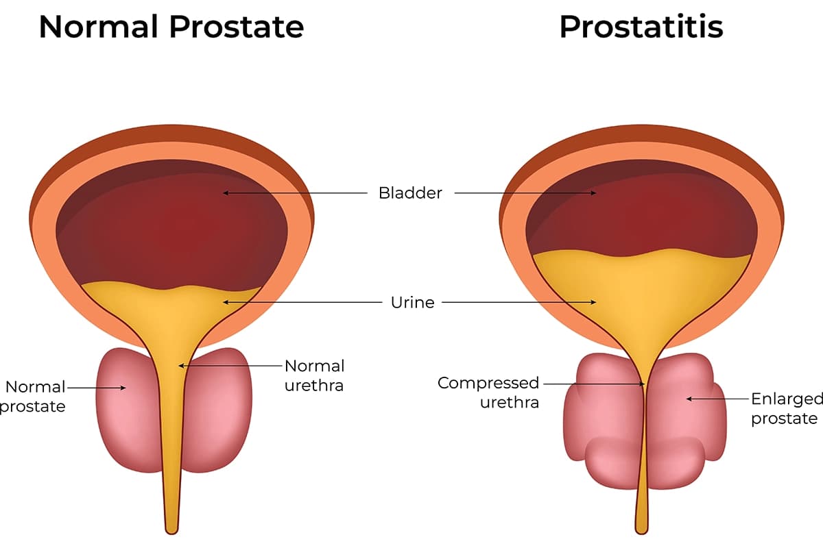 Robotic prostate surgery procedure