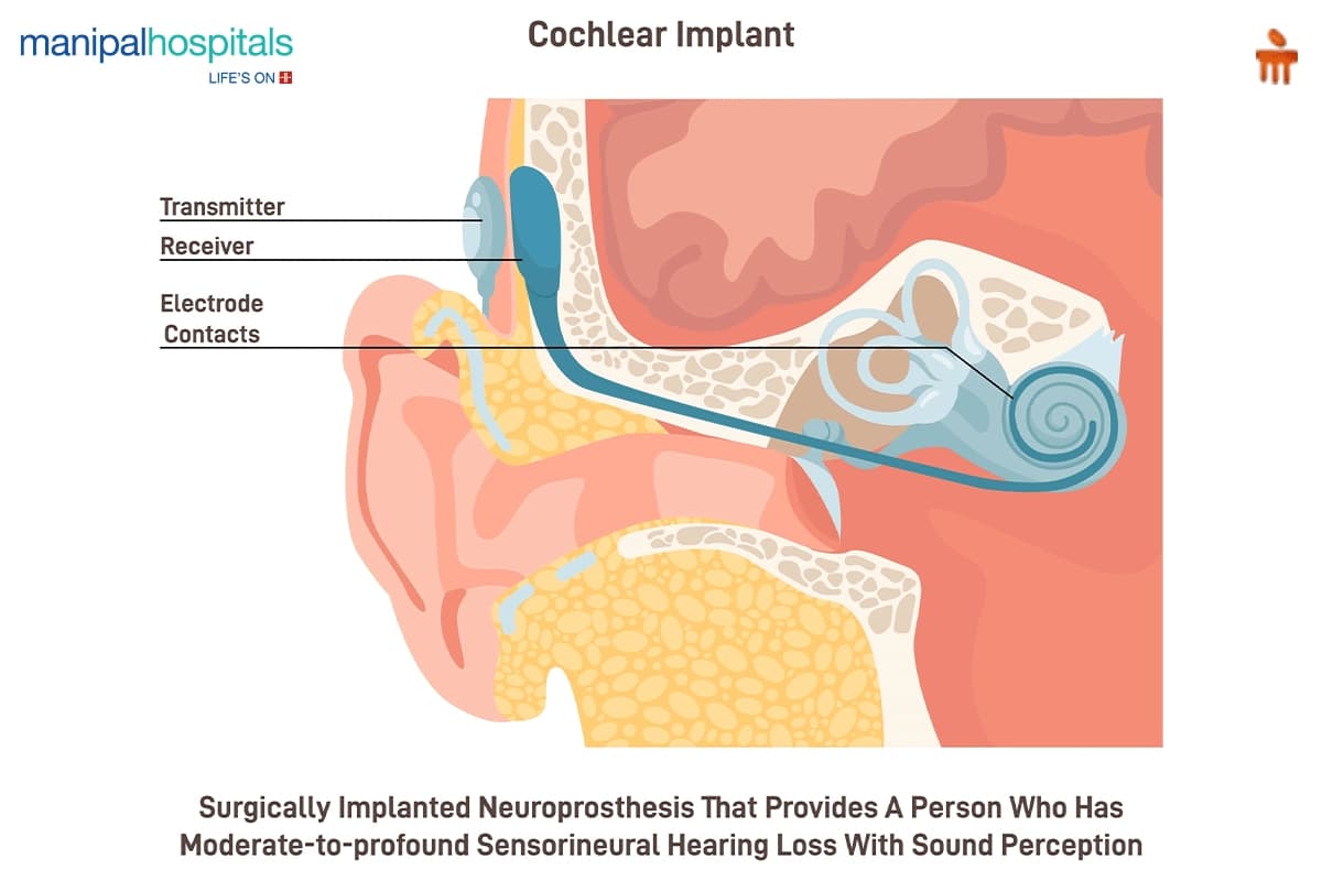 Who Needs a Cochlear Implant Signs You Should See an ENT Specialist infographics 1 Who Needs a Cochlear Implant Signs You Should See an ENT Specialist infographics 1