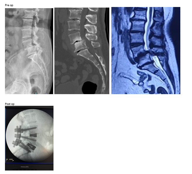 OLIF and ALIF surgeries
