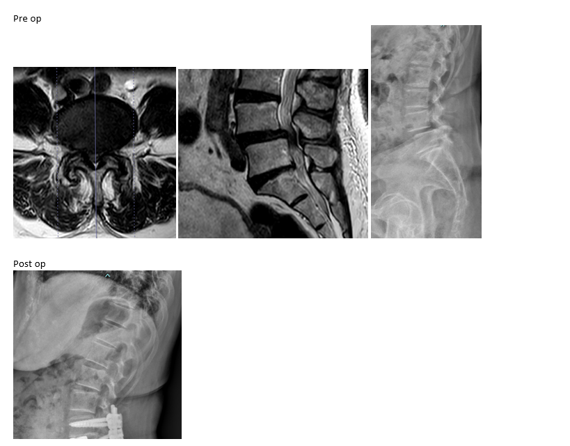 OLIF and ALIF surgery