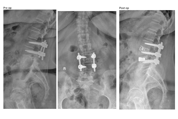 olif and alif surgery